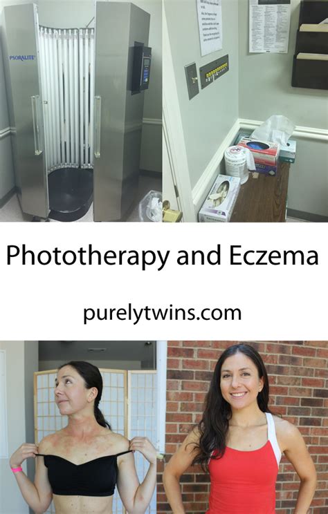 Phototherapy To Treat Eczema: Before And After Pictures, 58% OFF