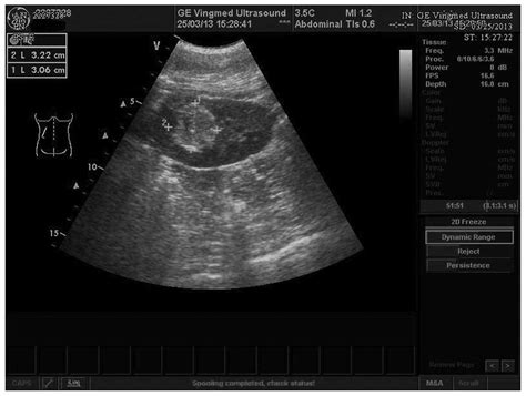 Kidney Tumor Ultrasound