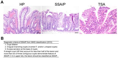 Hyperplastic Polyp