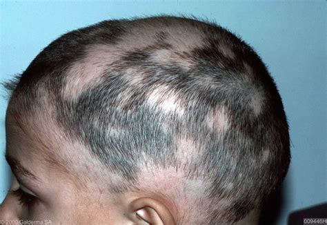 Alopecia areata causes, symptoms and best treatment for alopecia areata