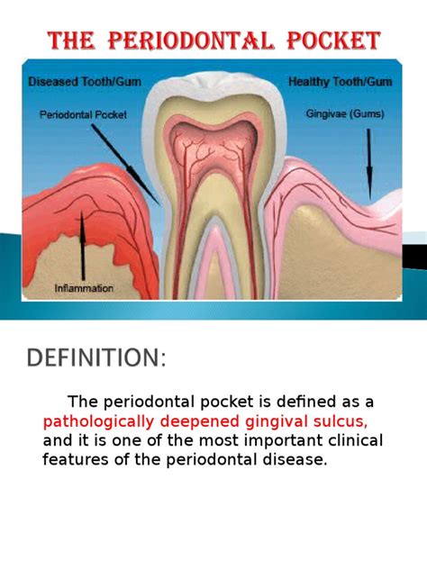 Periodontal Pocket | Dentistry Branches | Dentistry