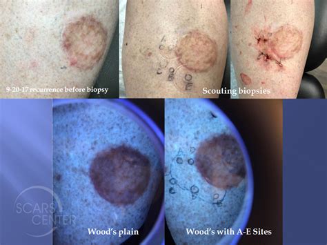 Mapping of Recurrent Melanoma In Situ of Leg - Skin Cancer and ...