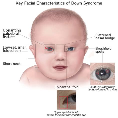 The association of Congenital Heart Defects & Down Syndrome - Blog