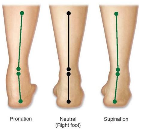 Pioneer Podiatry - Flat Feet, Collapsing Arches, Over-Pronation & High Arches