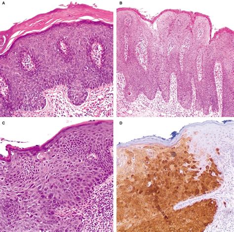 Vulvar Intraepithelial Neoplasia Wikipedia, 44% OFF