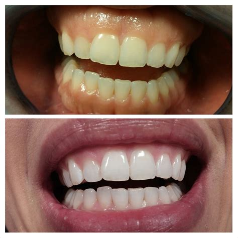 LED / Laser Teeth Whitening - Before & After Teeth Whitening Procedure ...