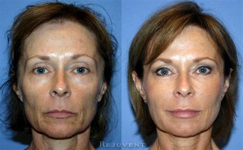 Liquid Facelift Photos Beautiful Results Rejuvent Scottsdale