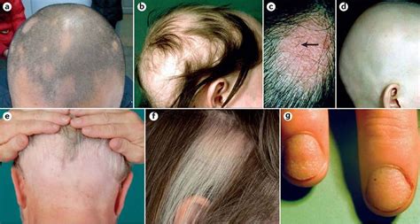 Alopecia areata causes, symptoms and best treatment for alopecia areata