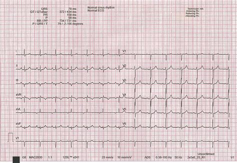 Normal Ecg Interpretation - Bank2home.com