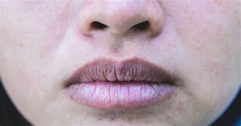 Are Dry Lips A Symptom Of Coronavirus | Lipstutorial.org