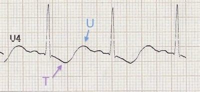 Hypokalemia Ecg Strip