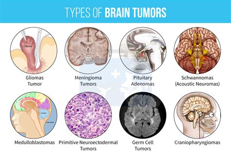 Brain Tumor Surgery: Types and Treatments ~ Healthcare In India