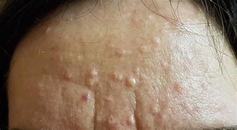 What Are These Small Bumps On My Face?- Sebaceous Hyperplasia By Joanna Koussertari