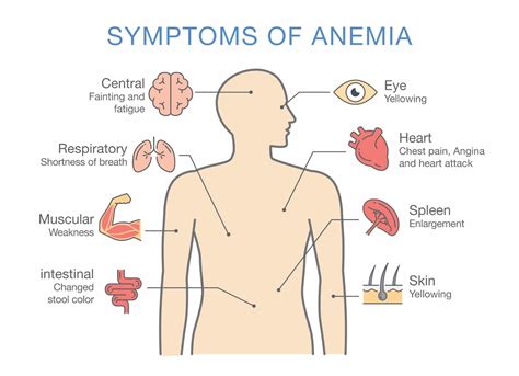 Iron Deficiency Anemia Symptoms