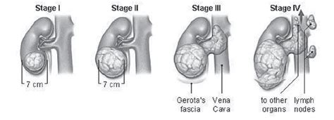 Stages of tumor growth in kidney. | Download Scientific Diagram