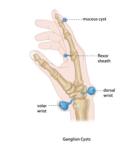 Ganglion Cyst | Randwick Plastic Surgery