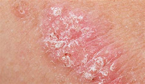 PSORIASIS – Dermatology Conditions and Treatments