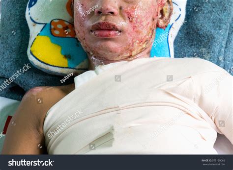 Nursing Care Patient Burn Unit Hospital Stock Photo 575159065 | Shutterstock