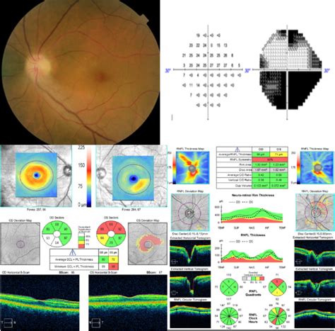 Case 2, 58-year-old female patient without any risk factors, diagnosed ...