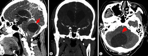 Arachnoid cyst causes, symptoms, diagnosis, prognosis and treatment