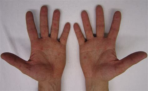 File:Characteristic rash of hand, foot, and mouth disease, on human hands.jpg - Wikimedia Commons