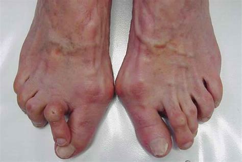 Hallux valgus deformity causes, hallux valgus bunion & treatment