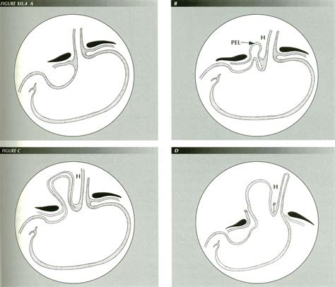 The Longitudinal Muscle in Esophageal Disease - "Hiatus Hernia" and ...