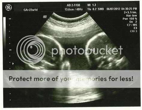 22 Weeks - ultrasound photo - BabyCenter