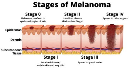 Stages of Melanoma - AIM at Melanoma Foundation