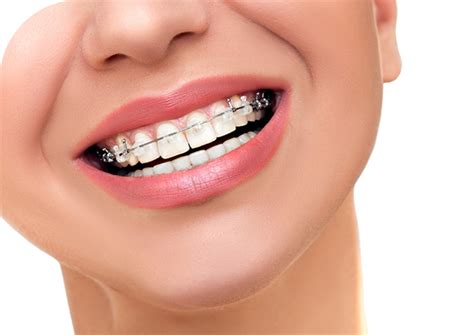 iSmile Dental Clinic Wagga Wagga – Broken braces and wires