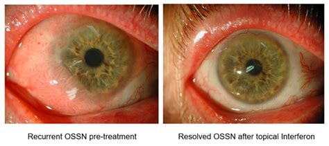 Ocular Surface Squamous Neoplasia | Brisbane Ophthalmologist & Eye Specialist