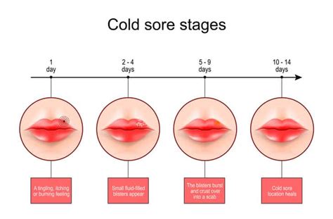 What is a Cold Sore? - Stasny Dental