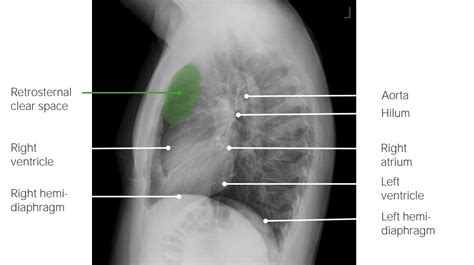 Lateral View Chest X Ray Anatomy