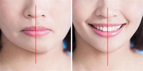 Jaw Surgery – Kikuchi Oral Surgery & Dental Implant Center