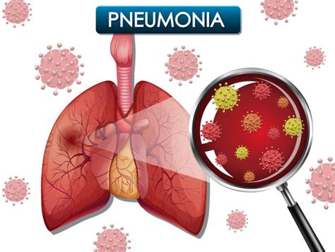 Pneumonia – Symptoms, Causes, Effect And Treatment | WHL