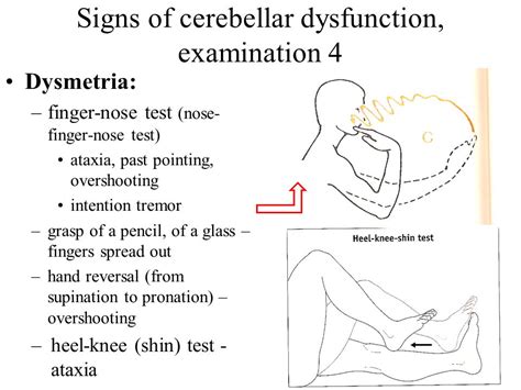 Dysmetria: What Is It, Causes, Diagnosis, Treatment, And, 46% OFF