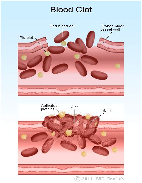 What is Haemophilia