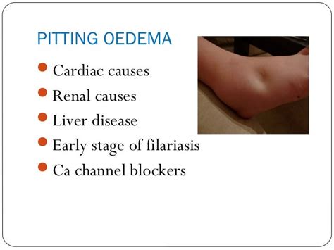 Causes of edema