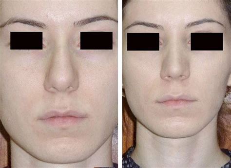 Deviated Septum Before And After Photos (6) » Rhinoplasty: Cost, Pics ...