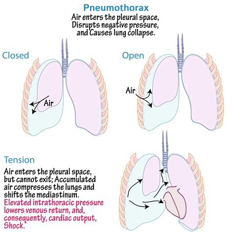 Pathology Glossary: Pneumothorax | Draw It to Know It