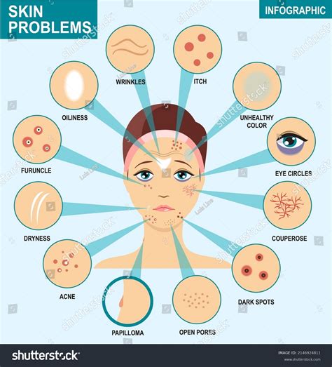 Skin Problems Infographics Woman Set Most Stock Vector (Royalty Free ...