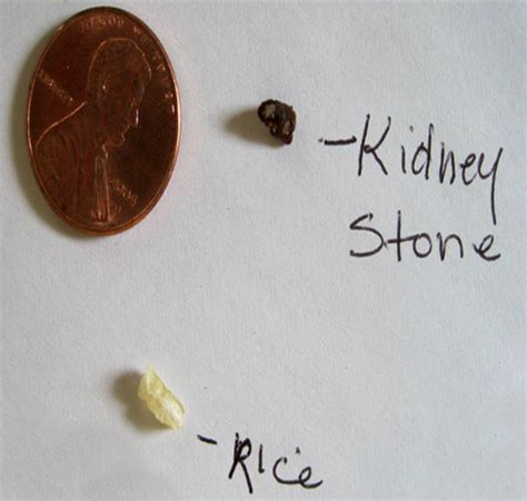 What are Kidney Stones? Causes, Symptoms and Treatments