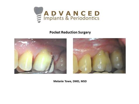 Pocket Reduction Surgery – Advanced Implants & Periodontics