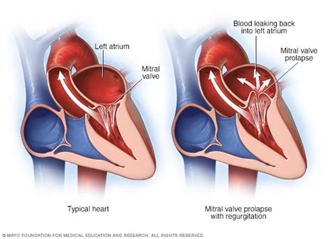 Mitral valve regurgitation - Symptoms and causes - Mayo Clinic