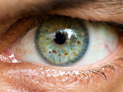 Brown Spot on Your Eye: What This Means and How to Treat It