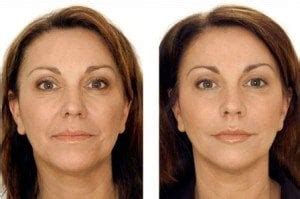 Wrinkle Fillers – Best Deep, Instant Injectable, Topical & OTC Face Wrinkle Filler Before and ...