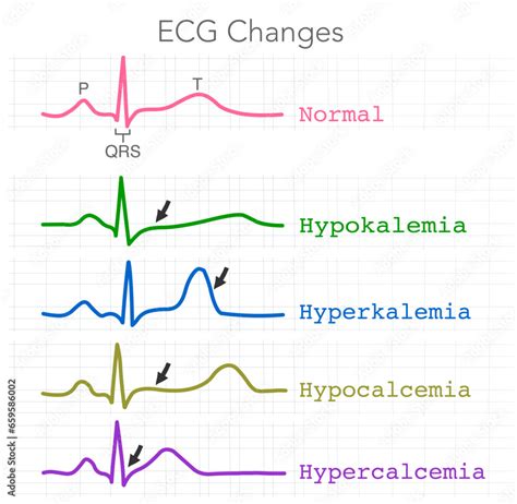 ECG changes. Hypokalemia, Hyperkalemia, Hypercalcemia, Hypocalcemia ...