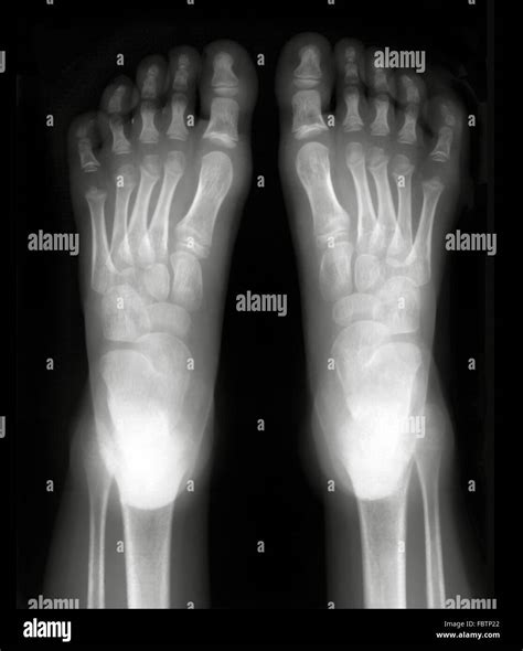 Xray Normal Foot