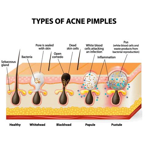 Acne Types | Albany Cosmetic and Laser Centre In Edmonton