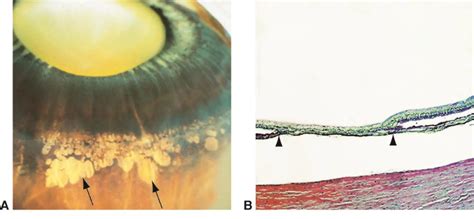 Paving-stone degeneration - American Academy of Ophthalmology